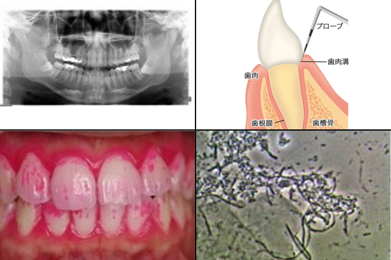 歯周病治療 さいたま市の矯正歯科 ホワイトニング インプラントなら T T歯科 矯正歯科クリニックへ