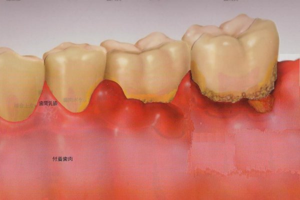 歯周病治療 さいたま市の矯正歯科 ホワイトニング インプラントなら T T歯科 矯正歯科クリニックへ