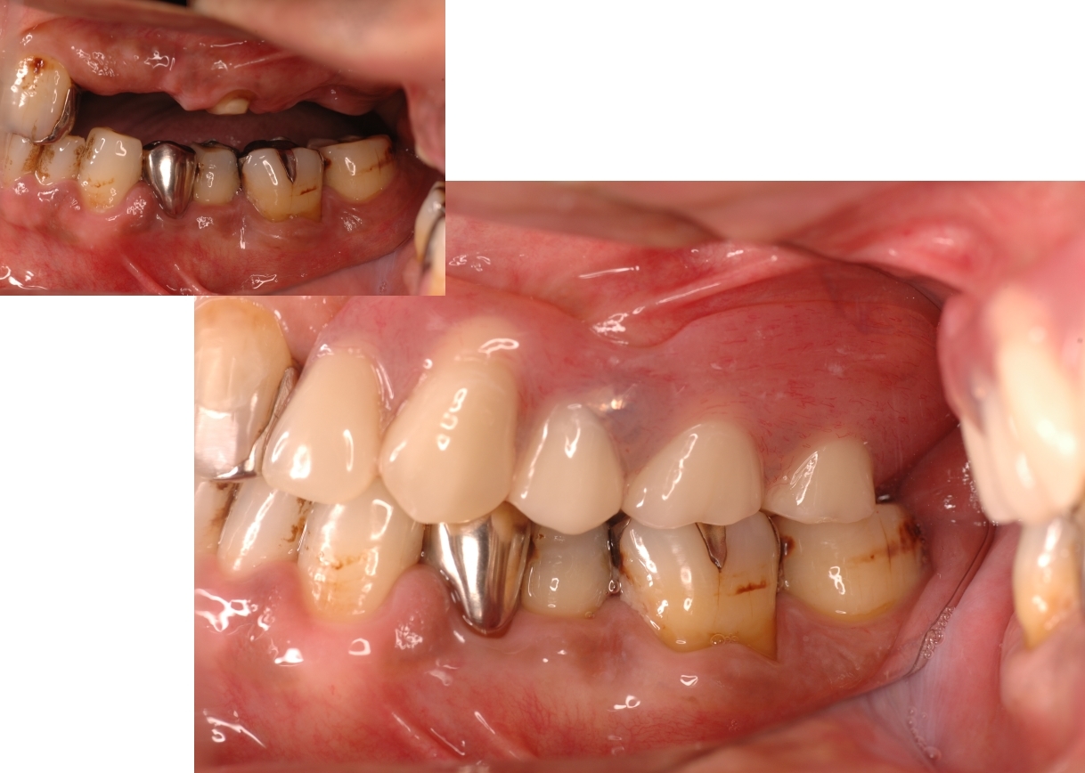審美歯科 さいたま市の矯正歯科 ホワイトニング インプラントなら T T歯科 矯正歯科クリニックへ 審美歯科 さいたま市の矯正歯科 ホワイトニング インプラントなら T T歯科 矯正歯科クリニックへ